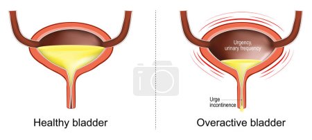 Illustration for Overactive bladder. Loss of bladder control. urge incontinence. Signs and symptoms of a Bladder dysfunction. Human urinary tract. Vector illustration - Royalty Free Image