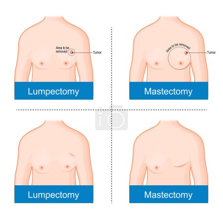Brustkrebsbehandlung vor und nach der Brustoperation. Unterschied zwischen Mastektomie und Lumpektomie. Chirurgische Onkologie. Vektorillustration