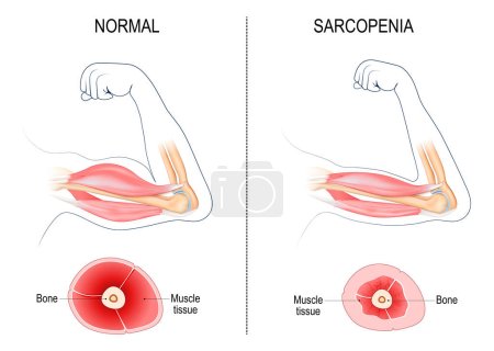 Sarcopenia. Atrofia muscular relacionada con la edad. Comparación y diferencia entre el brazo normal y la pérdida muscular. Sección transversal del músculo de la persona activa joven, y el viejo humano pasivo. Ilustración vectorial