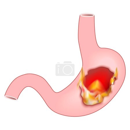 Illustration for Heartburn. Human stomach with flame. Pyrosis, cardialgia or acid indigestion. burning sensation in the stomach. Gastroesophageal reflux disease GERD. Vector illustration - Royalty Free Image