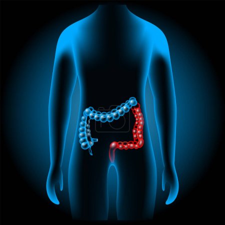 Illustration for Inflammatory bowel disease. Large intestine with glowing effect on a x-ray blue realistic torso. Gastrointestinal tract. Part of a human Digestive system on dark background. Image for healthcare design. Vector poster - Royalty Free Image