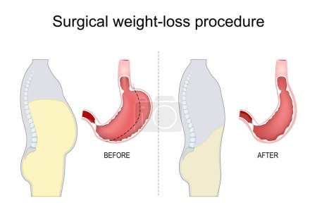 Illustration for Vertical sleeve gastrectomy. Stomach reduction. Surgical procedure. Bariatric surgery. Obesity treatment. Vector illustration - Royalty Free Image
