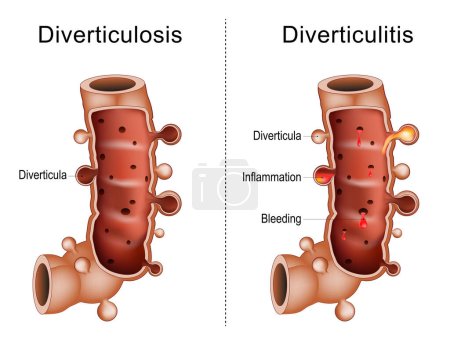 Illustration for Difference between diverticulitis and diverticulosis colon. Close-up of a Part of a large intestine with Diverticula, Bleeding,  and Inflammation, Human anatomy. Vector illustration - Royalty Free Image