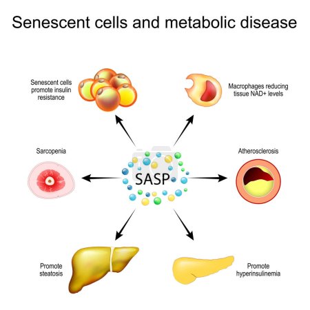 Illustration for Senescent cells and metabolic disease. Senescence-associated secretory phenotype SASP. Senescent cells promote insulin resistance, liver steatosis, muscle atrophy and Sarcopenia, hyperinsulinemia in pancreas, and atherosclerosis. Aging process and Ch - Royalty Free Image
