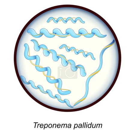 Treponema pallidum. Bakterien, die Krankheiten Syphilis, Bejel, Gähnen verursachen. Nahaufnahme eines bakteriellen Erregers. Sexuell übertragbare Krankheiten und Spirocheten-Infektionen. Genitalinfektion. Vektorplakat