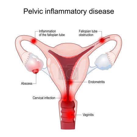 Illustration for Pelvic inflammatory disease. Cross section of a Uterus with symptoms of Inflammation, fallopian tube obstruction, endometritis, salpingitis, tubo-ovarian abscess, vaginitis and cervical infection. Female reproductive system and Sexually transmitted i - Royalty Free Image
