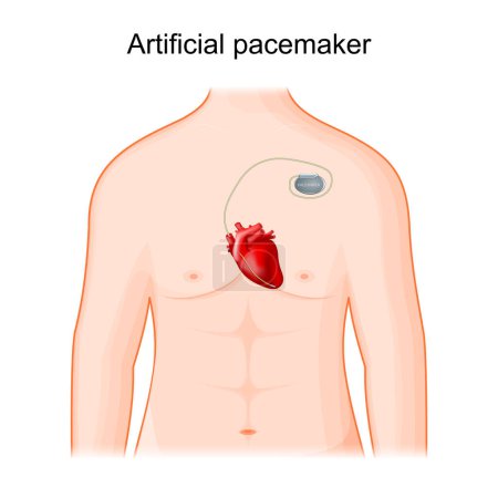 Illustration for Artificial cardiac pacemaker. Human heart with Single-chamber pacemaker. Implanted medical device, that generates electrical pulses delivered by electrodes to  lower ventricle. Vector illustration - Royalty Free Image