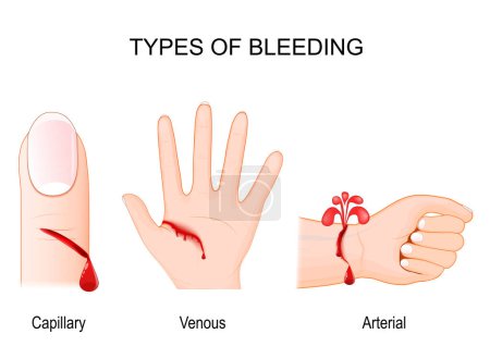 Tipos de sangrado. Una herida de sangrado capilar en el dedo. Palma con pérdida de sangre venosa. Mano humana con vaso sanguíneo dañado y hemorragia arterial. Ilustración vectorial