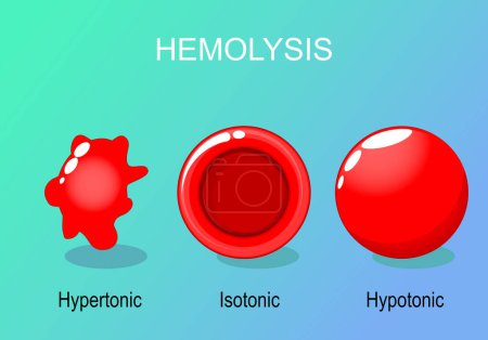 Ilustración de Hemólisis de glóbulos rojos. Eritrocitos hipertónicos, hipotónicos e isotónicos. Ilustración vectorial - Imagen libre de derechos