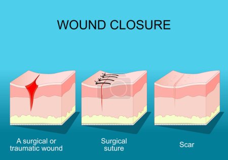Illustration for Wound healing. Skin before and after Wound Closure. From surgical or traumatic wound to suture and scar. A fibrous tissue replaces normal skin after an injury healing process. - Royalty Free Image