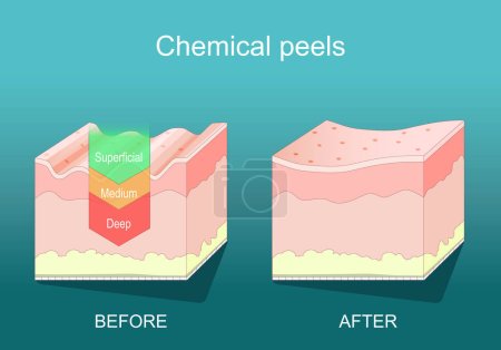 Chemical peel. Beauty aesthetic treatment. Deep, medium, Superficial peel. Dermatological procedure for Skin rejuvenation. Exfoliation. Cross section of a human skin. isometric flat vector illustration