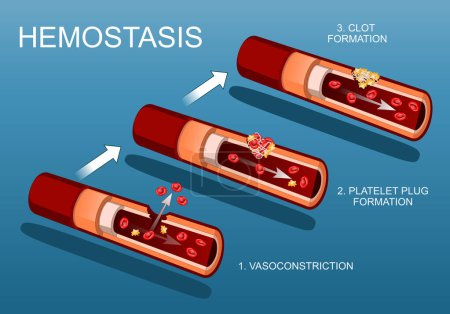 Illustration for Hemostasis and Wound healing. Coagulation. Basic steps from Vasoconstriction to Platelet plug formation. Cross section of an artery. Blood vessel injury and inflammation. Blood clotting. Blood vessel repair. Vector illustration - Royalty Free Image