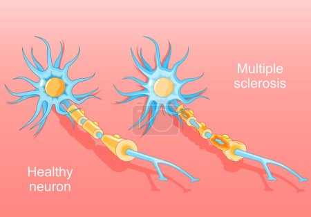 Esclerosis múltiple. Enfermedad autoinmune. neurona normal y una neurona con una vaina de mielina dañada. Daño nervioso. Vector isométrico. Ilustración plana