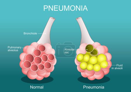 Pneumonie. Affection inflammatoire des poumons. Coupe transversale de l'alvéole normal, et les alvéoles sont remplis de liquides. Affiche vectorielle. Illustration plane isométrique.