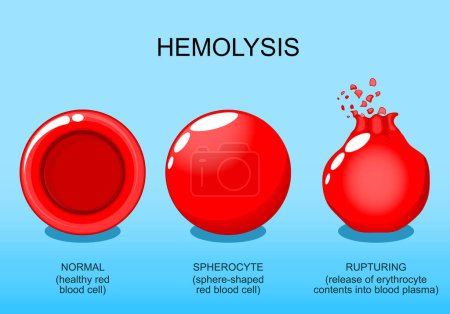 Illustration for Hemolysis. Normal red blood cell, spherocyte, and rupturing of erythrocyte. Osmotic pressure. Vector poster. Isometric Flat illustration. - Royalty Free Image