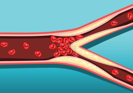 Aterosclerosis. La pared de la arteria se espesa como resultado de la acumulación de calcio, grasa y colesterol. Reduce la elasticidad de la arteria. Cartel vectorial. Ilustración plana isométrica.