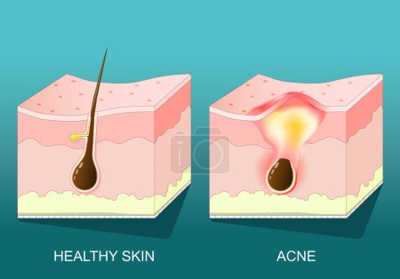 Illustration for Acne. Cross section of a human skin with pimple, redness and inflammation. Vector poster. Isometric Flat illustration. - Royalty Free Image