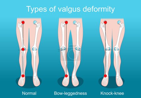deformidades valgus. Deformidad de rodilla. articulación saludable, golpe de rodilla y la pierna arqueada. Piernas, huesos y articulaciones humanas. Cirugía correctiva. Cartel vectorial. Ilustración plana isométrica.