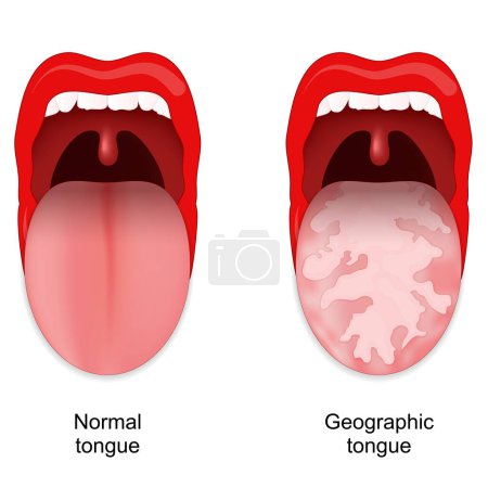 Geographic tongue. Benign migratory glossitis. Oral cavity anomalies. Vector illustration