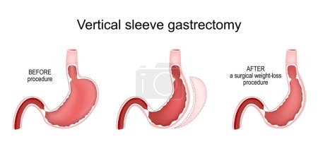 Gastrectomía de manga vertical. Estómago antes y después de un procedimiento quirúrgico de pérdida de peso. Cirugía bariátrica. Tratamiento de la obesidad. Sección transversal de un estómago humano. Ilustración vectorial