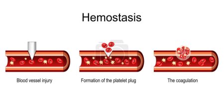 Hémostase. Coupe transversale d'un vaisseau sanguin après une blessure, formation du bouchon plaquettaire, coagulation et cicatrisation des plaies. Illustration vectorielle