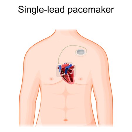 Illustration for Single lead pacemaker placement. Human body with cross section of hert and artificial cardiac pacemaker. Only one pacing lead is placed into a chamber of the heart, either the atrium or the ventricle. Vector illustration - Royalty Free Image