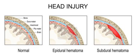 Hematoma epidural y hematoma subdural. Lesión cerebral traumática. Corte transversal de un cráneo humano. Primer plano de un cerebro Meninges. Pia mater, Dura matter, Arachnoid y Bone. Ilustración vectorial