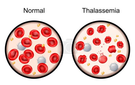 Thalassemia. Close-up of normal red blood cells, and damaged blood cells. Mediterranean anemia. Inherited blood disorders that result in abnormal hemoglobin. Vector illustration