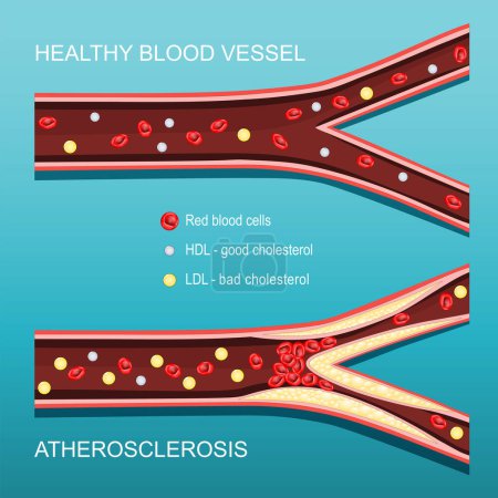 Atherosklerose. Cholesterinspiegel. Querschnitt einer Arterie mit roten Blutkörperchen, HDL, LDL und atheromatösen Plaques. Gutes und schlechtes Cholesterin. Vektorplakat. Isometrische flache Illustration.