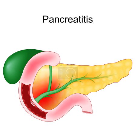 Illustration for Acute pancreatitis. Pancreas inflammation. Realistic vector Illustration of a duodenum, gallbladder and pancreas. - Royalty Free Image