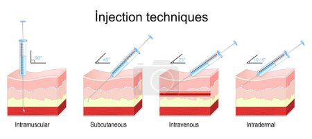 Injektionsmethoden. Querschnitt einer menschlichen Haut mit Spritze. Nadeleinführungswinkel für intramuskuläre, subkutane, intravenöse und intradermale Injektionen. Vektorillustration