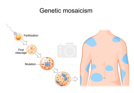 Mosaicismo genético. Mutación somática. Errores de replicación de ADN. Desarrollo celular desde la fertilización hasta la morula con mutación. Cuerpo humano con áreas afectadas. Edición somática del genoma. Ilustración vectorial
