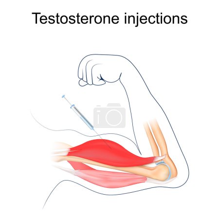 Testosterone injection. Anabolic steroids. Bodybuilding. Muscle enhancement. Human Biceps. Vector illustration