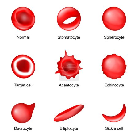 Ilustración de Forma de glóbulos rojos. drepanocitos, equinocitos, esferocitos, eliptocitos, acantocitos, estomatocitos, dacrocitos, células diana y eritrocitos normales. Poikilocitosis. Enfermedades sanguíneas. Ilustración vectorial - Imagen libre de derechos