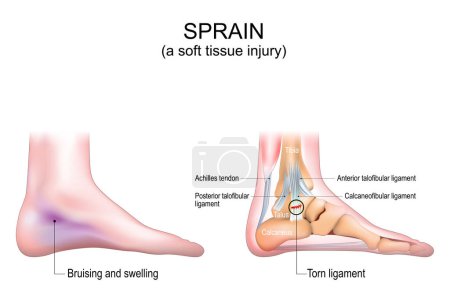 Esguince. Una lesión de tejido blando en el pie humano. Moretones e hinchazón de la piel de las piernas. Primer plano de un tendón de Aquiles, huesos del pie y ligamentos. Desgarrado de ligamento calcaneofibular. Ilustración vectorial