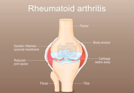 Rheumatoide Arthritis RA. Entzündliche Art der Arthritis, die das Knie betrifft. Autoimmunerkrankungen. Das Immunsystem greift fälschlicherweise gesundes Gelenkgewebe an. Gelenkdeformität. Isometrische Darstellung des flachen Vektors