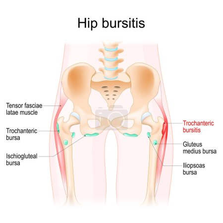 Illustration for Hip bursitis. Muscles, Synovial bursas and bones of a human hip. Trochanteric bursitis. Realistic vector illustration - Royalty Free Image