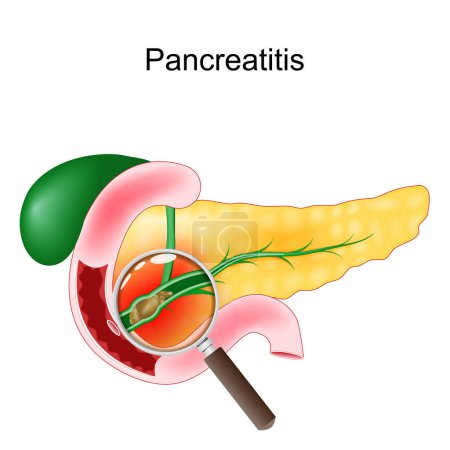 Pancreatitis aguda. Primer plano de un páncreas, duodeno y vesícula biliar realistas. Corte transversal de un conducto pancreático con vista de cálculos biliares a través de una lupa. ilustración vectorial