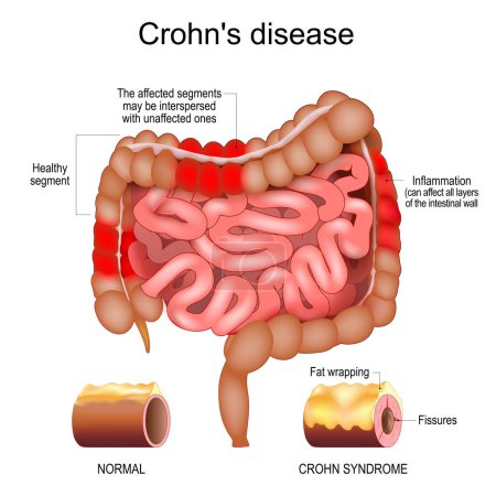 Crohn disease. Human large and small intestine with Healthy segments and Inflammation that affect  layers of the intestinal wall. The affected segments interspersed with unaffected ones. Close-up of a cross section of a intestinal wall with Fat wrapp