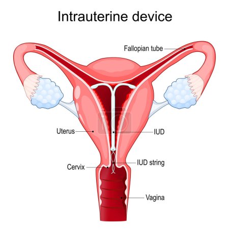 Dispositivo intrauterino o bobina. DIU. anticonceptivo intrauterino para el control de la natalidad. Sección transversal de un útero humano con DIU o DAI en el interior. Ilustración vectorial