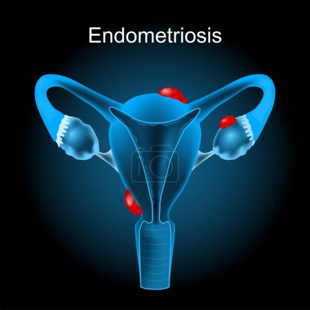 Endometriosis. Cross section of a human uterus with Endometrial tissue. female reproductive system. Vector illustration like X-ray image. Reproductive health.