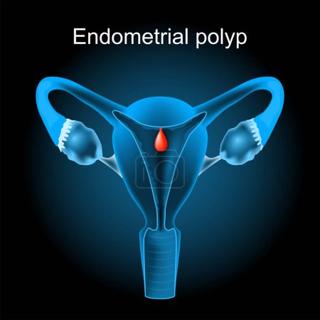 Endometriumpolyp. Querschnitt einer menschlichen Gebärmutter mit Uteruspolypen. weibliches Fortpflanzungssystem. Vektorillustration wie Röntgenbild. Reproduktive Gesundheit.