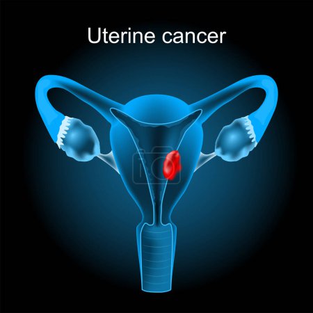 Uterine cancer. Cross section of a human uterus with Endometrial tumor. female reproductive system. Vector illustration like X-ray image. Reproductive health.