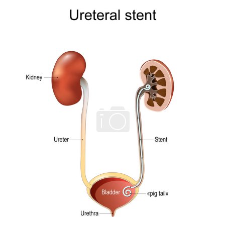 Stent ureteral. Cólico renal. Sistema urinario humano. sección transversal de riñón y vejiga con stent de cola de cerdo. ilustración vectorial aislada sobre fondo blanco.