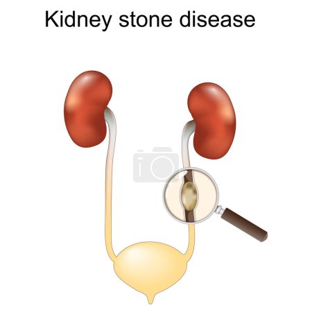 Kidney stone disease. Renal colic. Human Urinary System. Magnifying glass and Close-up of a stone into Ureter. vector illustration isolated on white background.