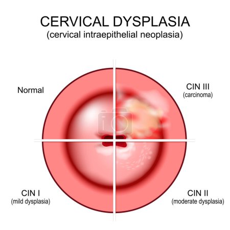 Illustration for Cervical dysplasia. Close-up of a cervix. Cervical cancer. Cervical intraepithelial neoplasia development from normal tissue and CIN I with mild dysplasia to moderate dysplasia and squamous cell carcinoma. vector illustration isolated on white backgr - Royalty Free Image