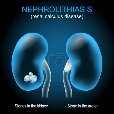 Kidney stone disease. Renal calculus disease. Nephrolithiasis or urolithiasis. Renal calculus that develops in the urinary tract. Vector illustration like X-ray image for healthcare design. Realistic transparent blue kidney with stones and stone in u