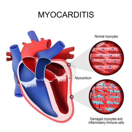 Ilustración de Miocarditis. miocardiopatía inflamatoria. Sección transversal de un corazón humano y miocardio. Primer plano de un miocito normal, miocitos dañados y células inmunitarias inflamatorias. miocardiopatía adquirida debido a la inflamación del músculo cardíaco. Vector illustrati - Imagen libre de derechos