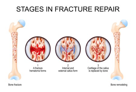 Stages in fracture repair. From Bone fracture and hematoma forms to Cartilage of the callus is replaced by bone and Bone remodeling. Vector illustration