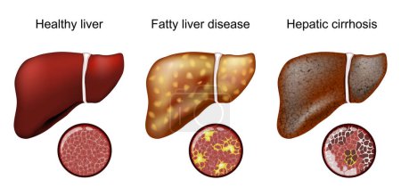 Fatty liver disease. Hepatic cirrhosis. Close-up of histology. Magnification of normal hepatocytes and cells of Fatty liver and cirrhosis. Vector illustration